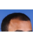 Before Hair Transplant&nbsp;Front